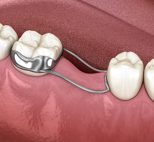 Animated smile with interceptive orthodontics appliance
